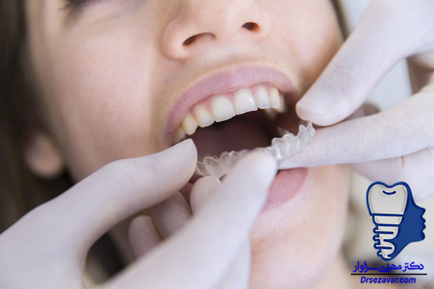 بهداشت دندان در زمان ارتودنسی متحرک