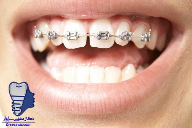 ارتودنسي يک فک ارتودنسی ثابت یک فک