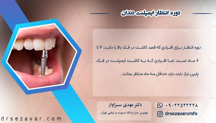 دوره انتظار ایمپلنت دندان