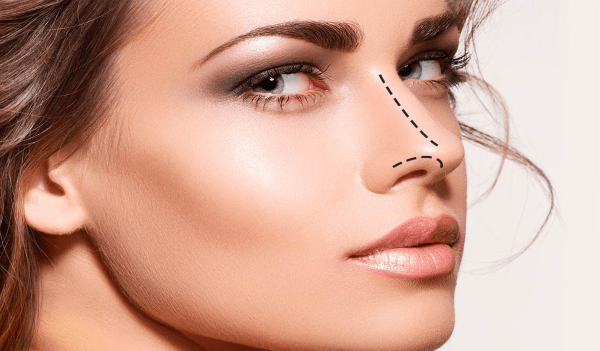 Rhinoplasty5 Min