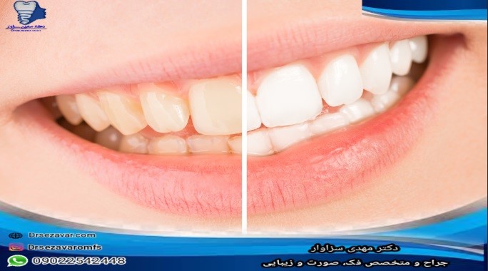 تغییر رنگ دندان‌ها