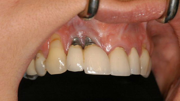 ایمپلنت دندان چه زمانی می‌افتد؟