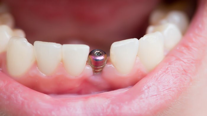 بهترین جراح ایمپلنت تهران