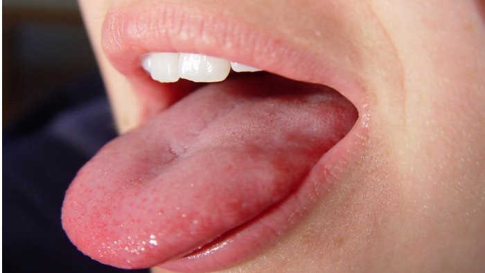 تورم و التهاب زبان چیست؟