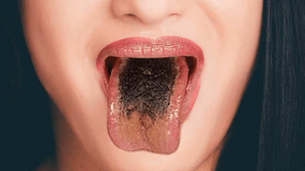 درمان خال زبان