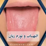 التهاب و تورم زبان