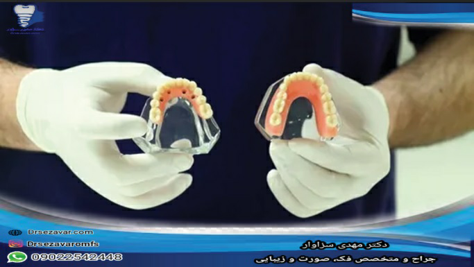 هنگام انتخاب دندان مصنوعی و ایمپلنت باید به چه نکاتی توجه داشته باشیم؟