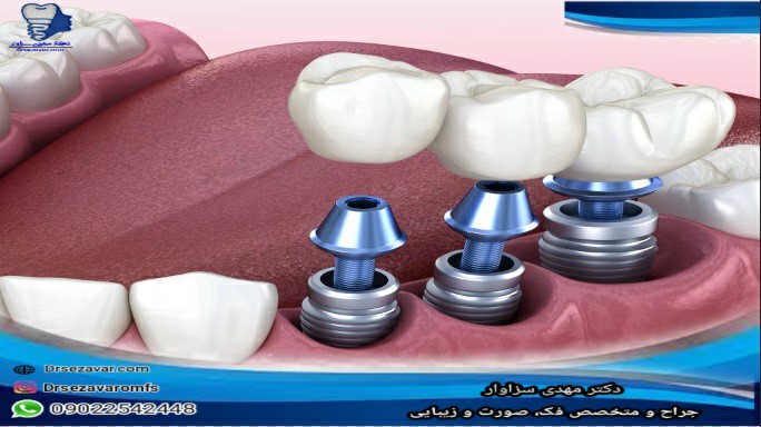 بعد از جراحی ایمپلنت دندان چه انتظاری داشته باشیم؟