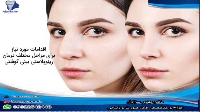 اقدامات-مورد-نیاز-برای-جراحی-بینی-گوشتی