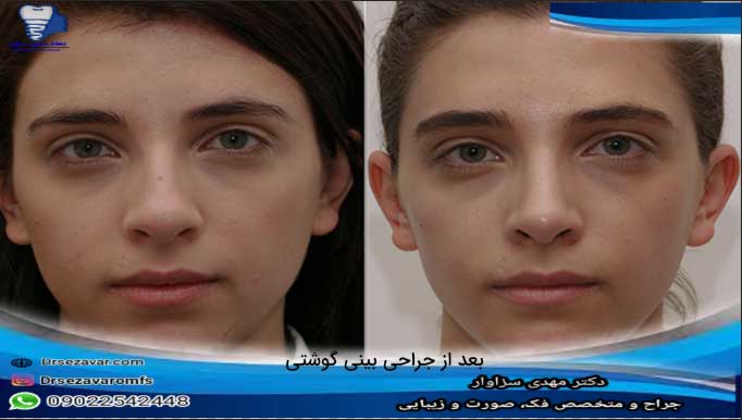 بعد-از-رینوپلاستی-بینی-گوشتی