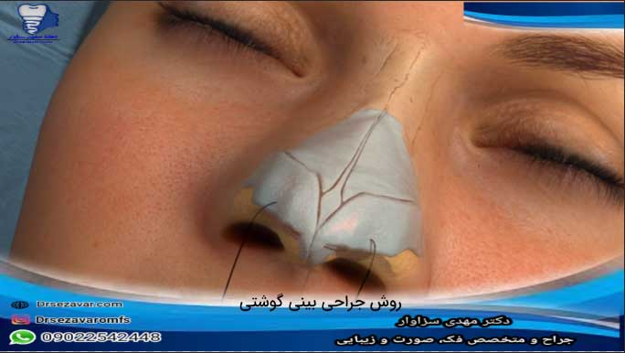 روش-جراحی-بینی-گوشتی