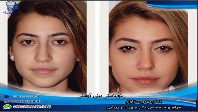 رینوپلاستی-بینی-گوشتی