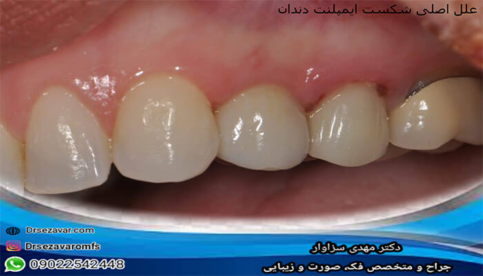 علل اصلی شکست ایمپلنت دندان