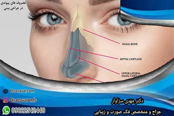 غضروف های پیوندی در جراحی بینی