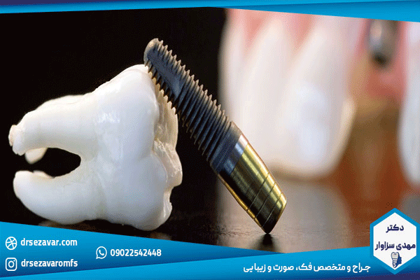علت تفاوت قیمت در ایمپلنت دندان