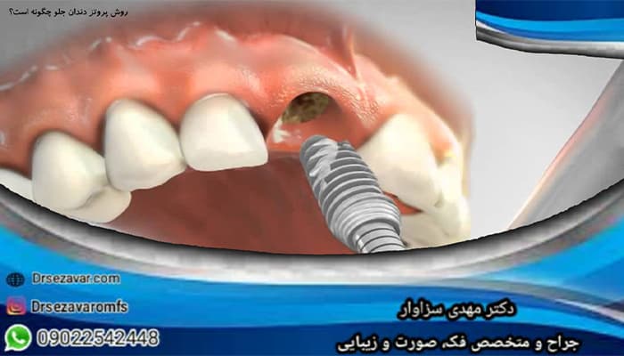 روش پروتز دندان جلو چگونه است