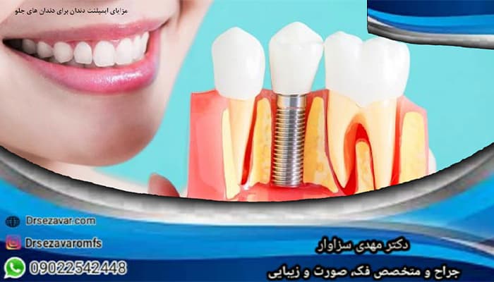 مزایای ایمپلنت دندان برای دندان های جلو