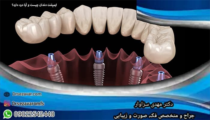 روش ایمپلنت دندان چگونه است