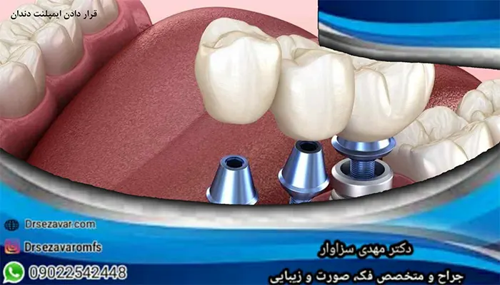 قرار دادن ایمپلنت دندان
