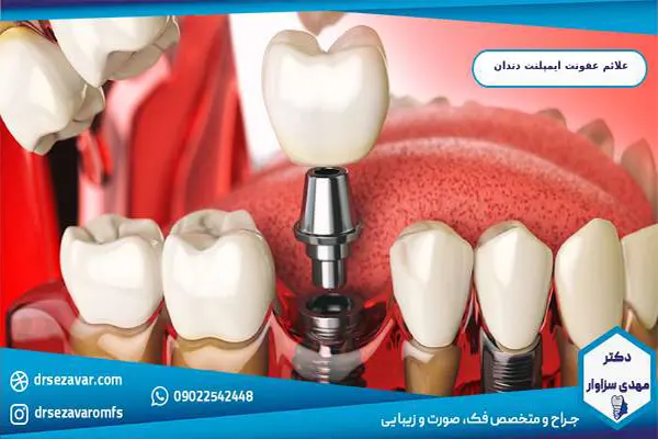 علائم عفونت ایمپلنت دندان