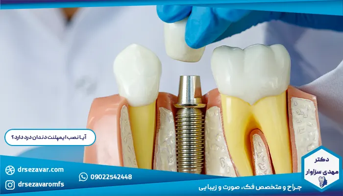 آیا نصب ایمپلنت دندان درد دارد؟