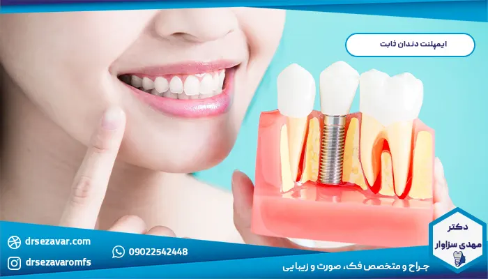 ایمپلنت دندان ثابت