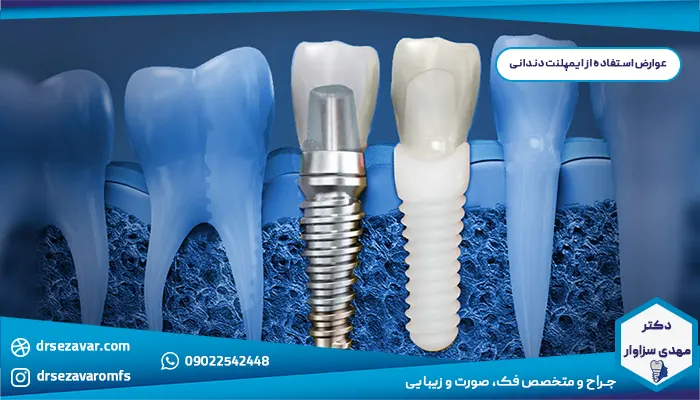 عوارض استفاده از ایمپلنت دندانی