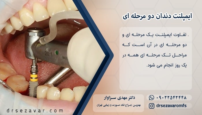 ایمپلنت دندان دو مرحله ای
