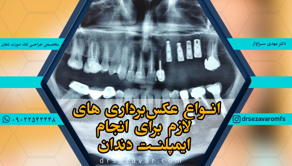 انواع عکس‌برداری های لازم برای انجام ایمپلنت دندان
