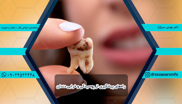 راه‌های پیشگیری از پوسیدگی و خرابی دندان