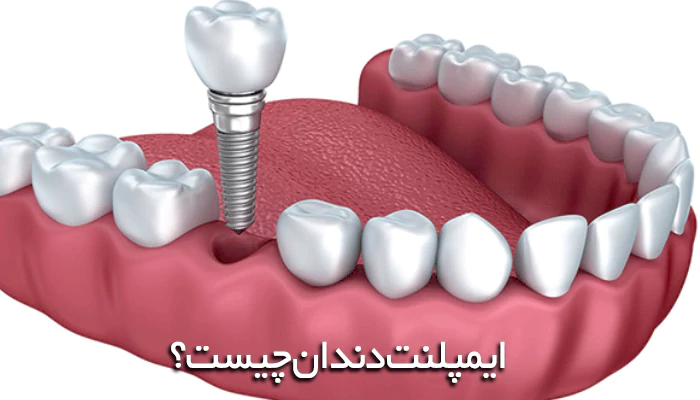 ایمپلنت‌ دندان چیست؟