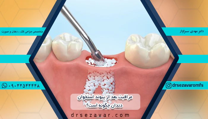 مراقبت بعد از پیوند استخوان دندان چگونه است