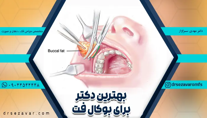 بهترین جراح بوکال فت در تهران