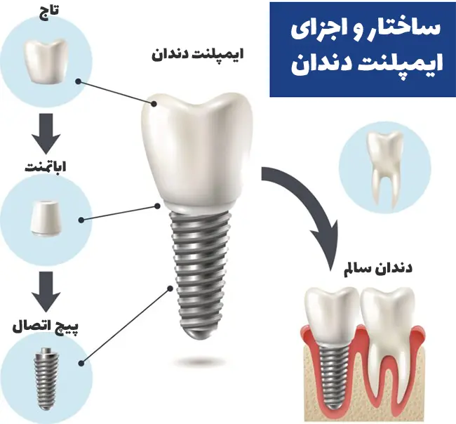 اجزای ایمپلنت دندان