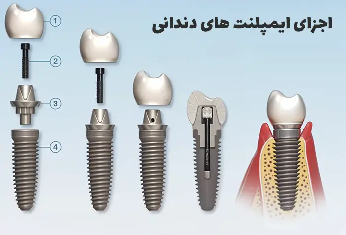 ساختمان ایمپلنت دندان