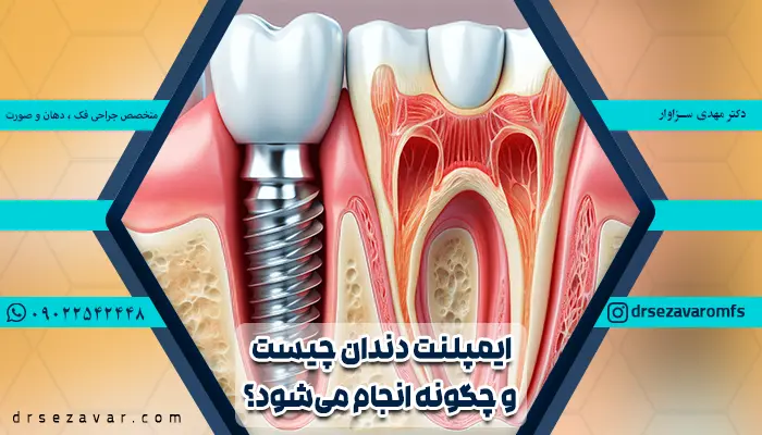 ایمپلنت دندان