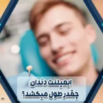 ایمپلنت دندان چقدر طول می کشد