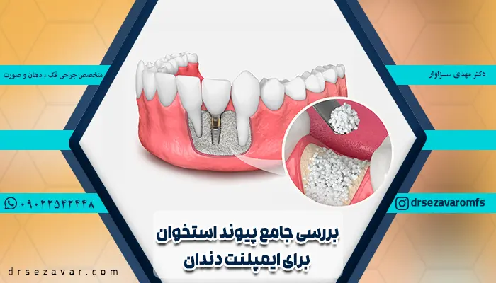 پیوند استخوان در ایمپلنت دندان