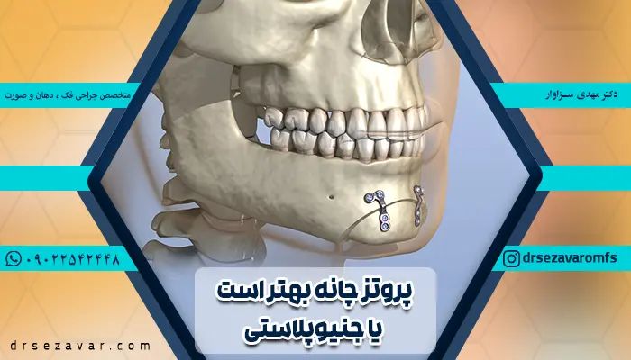 پروتز چانه بهتر است یا جنیوپلاستی؟