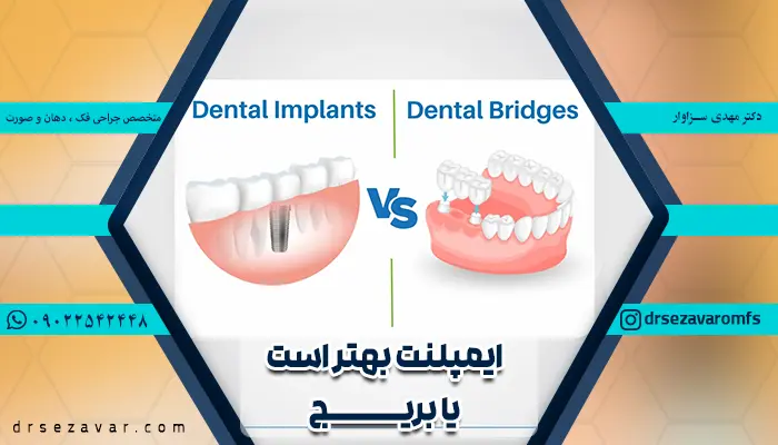 تفاوت بریج و ایمپلنت دندان