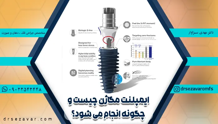 ایمپلنت مگاژن کره
