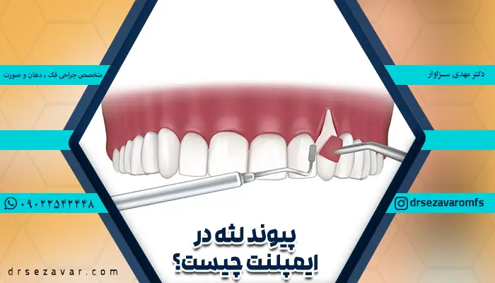 پیوند لثه در ایمپلنت