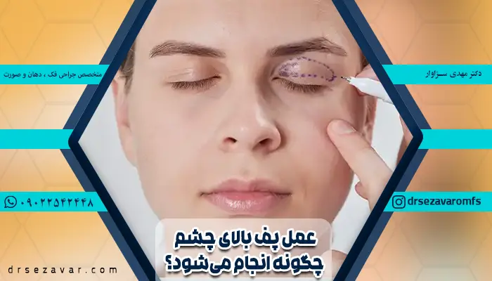 عمل پف بالای چشم