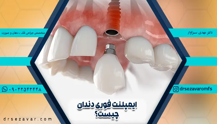 ایمپلنت فوری دندان