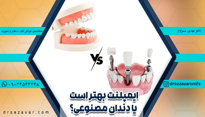 مقایسه ایمپلنت دندان و دندان مصنوعی
