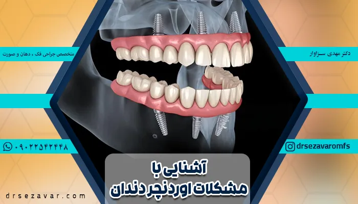 تصویر شماتیک اوردنچر دندان در فک