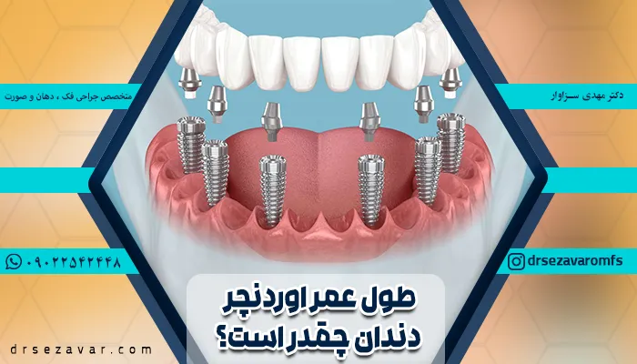 تصویر شماتیک پایه و ابانتمنت اوردنچر دندان