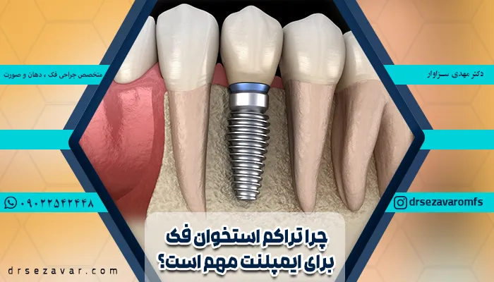 اسخوان فک متراکم و پایه تیتانیومی ایمپلنت دندان