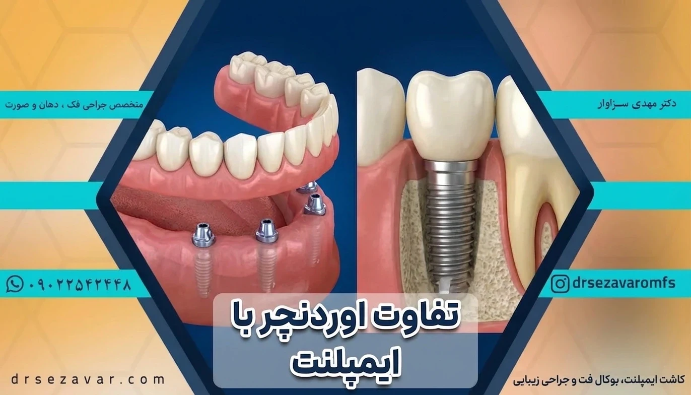مقایسه تصویری و نحوه کاشت ایمپلنت دندان و اوردنچر