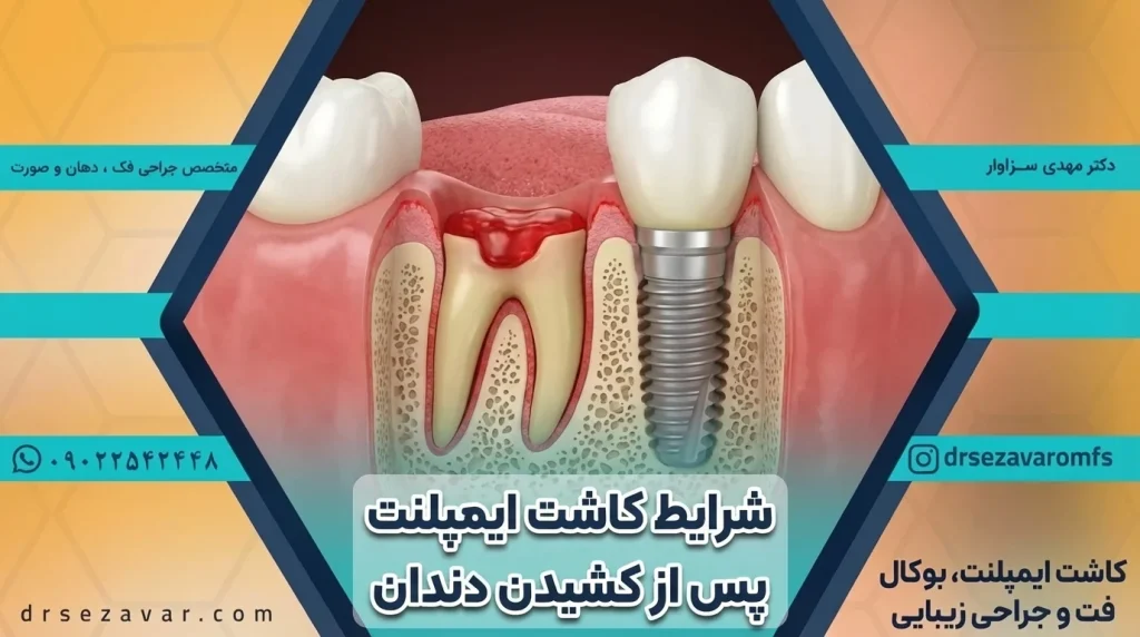 بررسی سلامت فک و ریشه دندان برای شرایط کاشت ایمپلنت پس از کشیدن دندان
